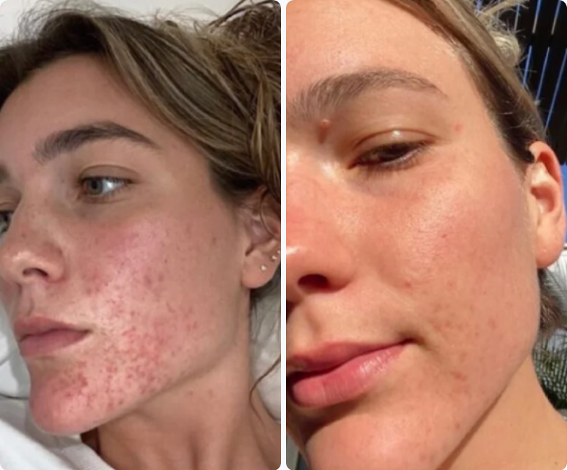 Sophie D. - Before and After Clarexin